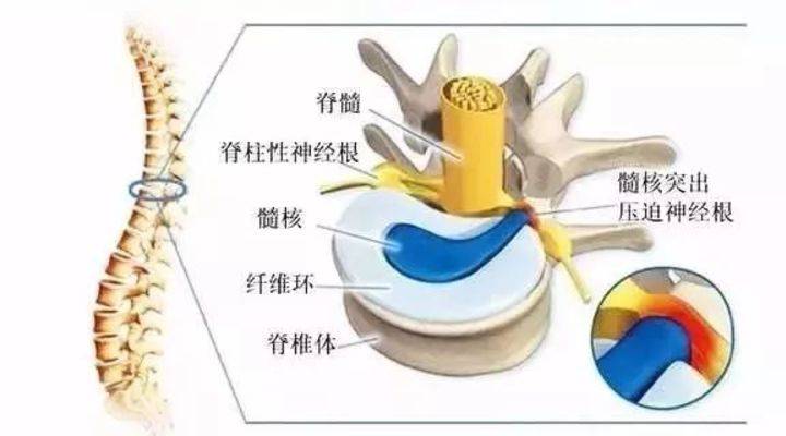 11月2日根線蟲最新根治法詳解，有效治療根線蟲的方法與解析