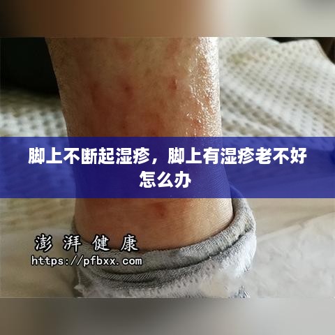 腳上不斷起濕疹，腳上有濕疹老不好怎么辦 