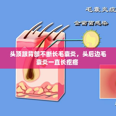 頭頂跟背部不斷長毛囊炎，頭后邊毛囊炎一直長疙瘩 